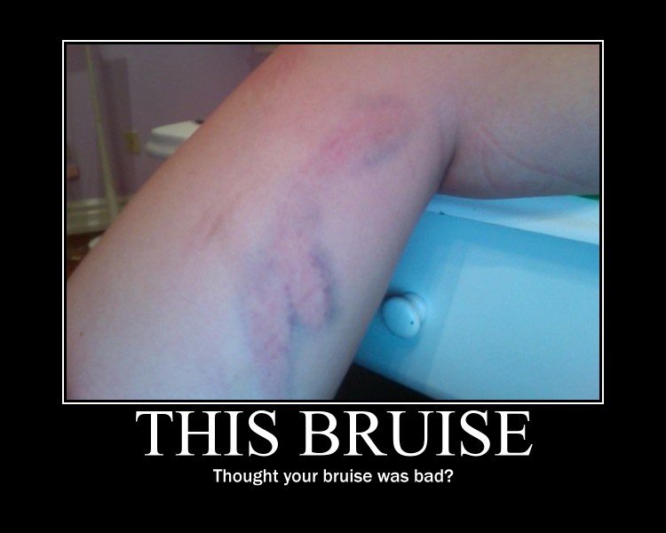 anime bruise