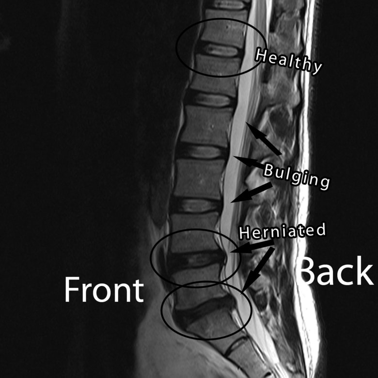 my-lower-back-mri-results